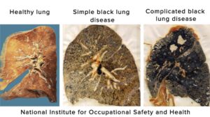 National Institute of Occupational Safety and Health: a visual comparison between a healthy lung, a lung with simple black lung disease and a lung with complicated black lung disease.